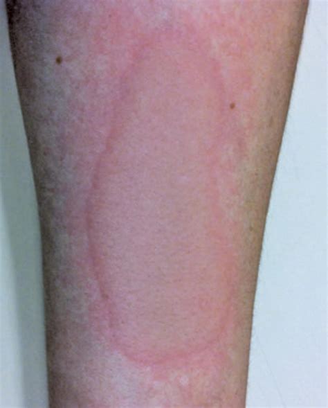 Chronic Inducible Urticaria Confirmation Through Challenge Tests And