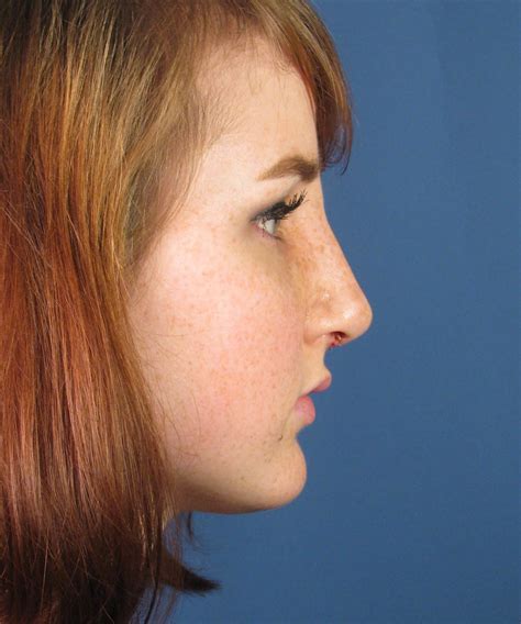 Female Nasal Hump Refinement Rhinoplasty In San Diego Ca Dr Hilinski