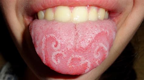 White Spots On Tongue Tip Side Under Back Dots Patches Single