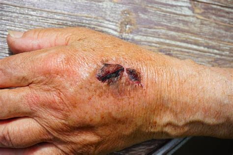 What You Need To Know About Picking On Scabs Dose Of Healthcare