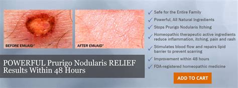 Reduce Prurigo Nodularis Bumps With Emuaid® Emuaid® Official Site