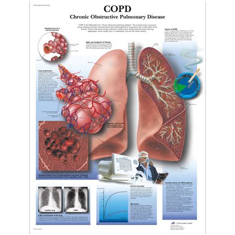 Copd Chart Chronic Obstructive Pulmonary Disease Sem Trainers