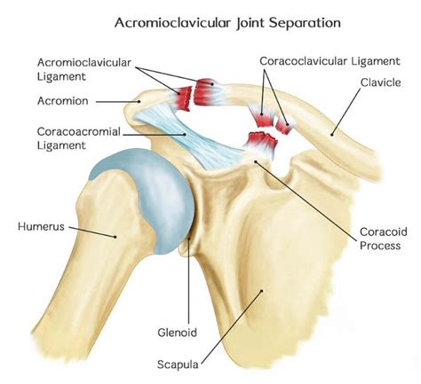 The shoulder is made up of two joints, the acromioclavicular joint and the glenohumeral joint. AC Joint Injuries - Best Knee Replacement and Arthroscopy ...
