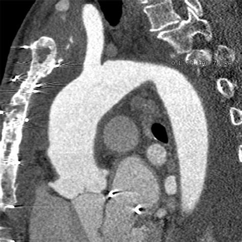 Thoracic Computed Tomography Of The Ascending Aorta Sagittal Plane