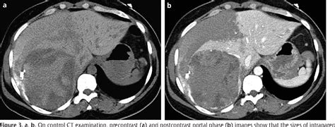 PDF Multidetector CT Findings Of Spontaneous Rupture Of Hepatic