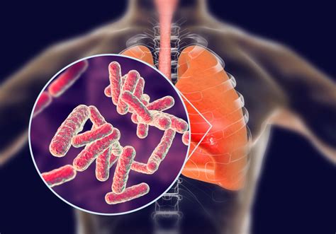 Study Immunologic Tuberculosis Is Not Life Long Infection