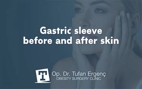 Gastric Sleeve Before And After Skin Opdr Tufan Ergenc