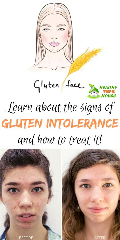 Learn About The Signs Of Gluten Intolerance And How To Treat It