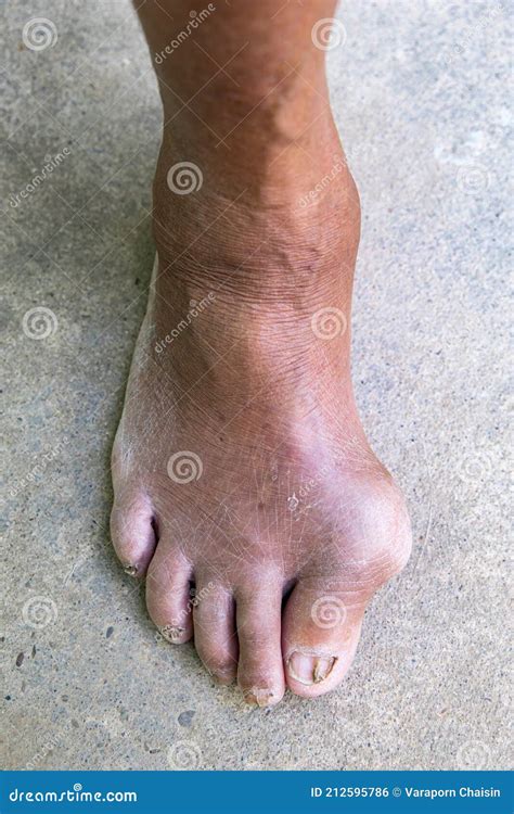 Gout Inflammation On Big Toe Joint And Fungal Nail Infection Stock