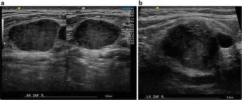 Sonographic Appearance Of Abnormal Cervical Lymph Nodes In The