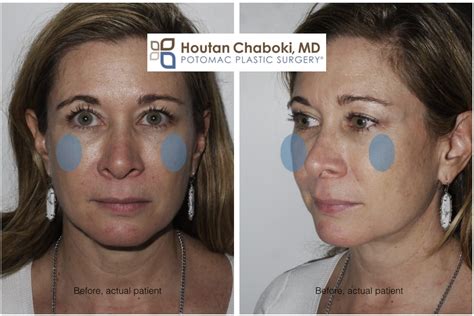 Cheek Augmentation With Fillers Potomac Plastic Surgery