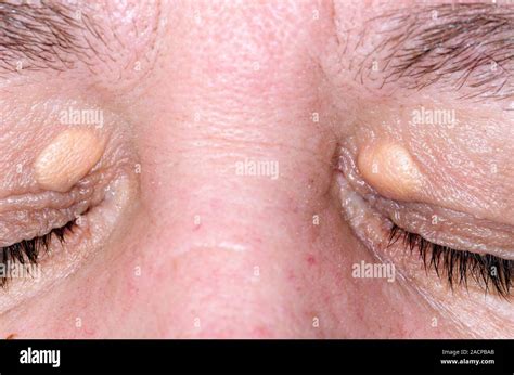 Xanthelasma Yellow Swellings On The Eyelids In A 47 Year Old Female
