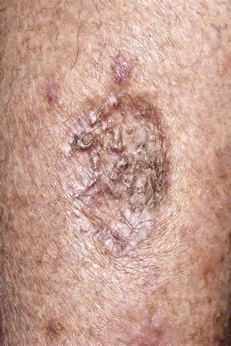 Scar After Cancer Removal Stock Image C0294951 Science Photo Library
