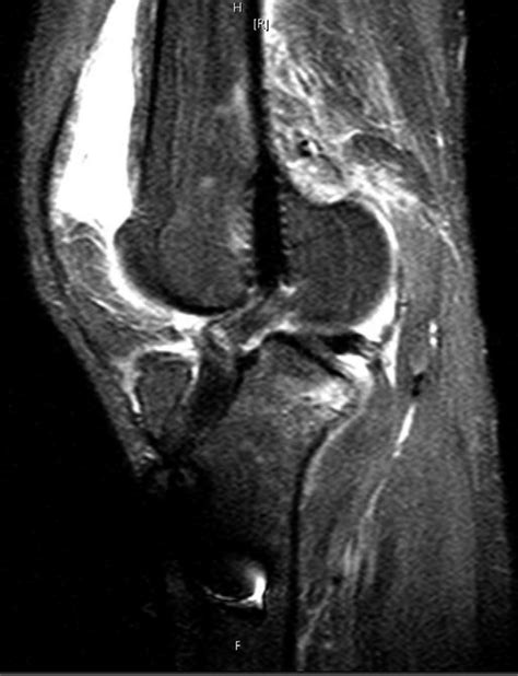 T2 Weighted Magnetic Resonance Imaging Sagittal View Of The Right Knee