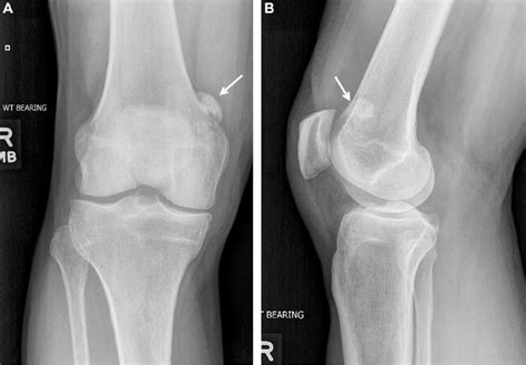 E A Frontal And B Lateral Knee Radiographs Demonstrate An Area Of