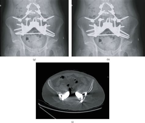 Figure 4 From Use Of A 3d Printed Patient Specific Surgical Jig And
