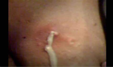 Gigantic Pimple Explosion New Pimple Popping Videos