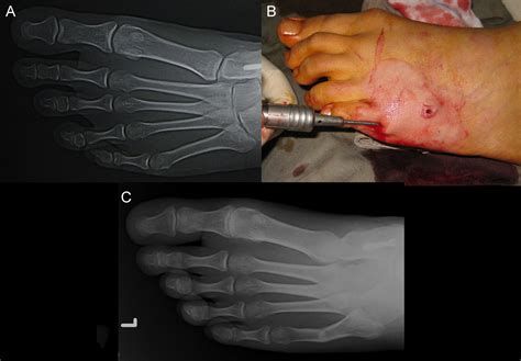 Percutaneous Osteotomy Of The Fifth Metatarsal For Symptomatic