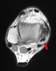 Mri Musculo Skeletal Section Split Of Tibialis Posterior My XXX Hot Girl