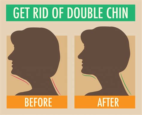 how to reduce double chin with best kybella treatment laser klinic