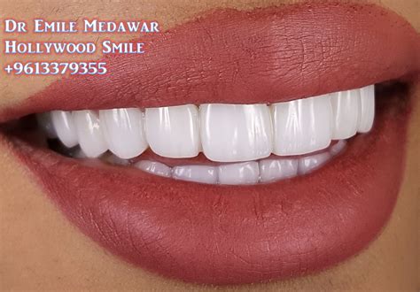 Cosmetic Dentistry Beautiful Hollywood Smile Ultra Thin Digital