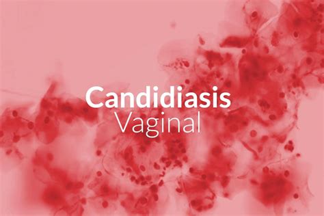 Candidiasis Vaginal Viasek Gel