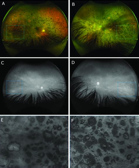 Ultra Widefield Uwf 200° Fundus Photos Of The Right Eye A And Left