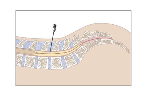 Lumbar Puncture Nhs