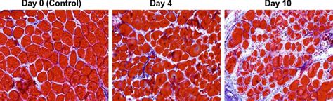 Out Of Step Cells Spur Muscle Fibrosis In Duchenne Muscular Dystrophy Patients