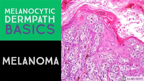 Melanocytic Dermpath Basics Melanoma Youtube