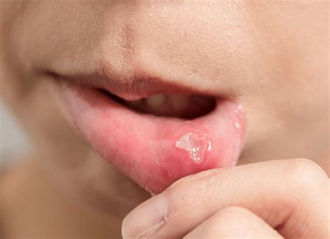 Tiny Bumps On Mouth Roof Bumps On Roof Of Your Mouth 11 Potential