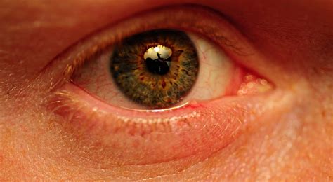 An Eyelid Lump • Litfl • Ophthalmology Befuddler