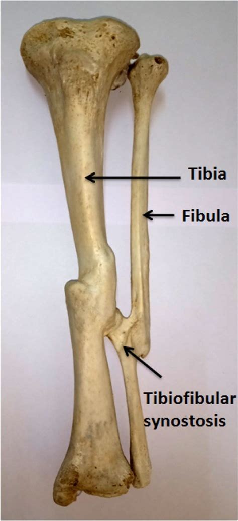 Left Tibia And Fibula Anterior View Showing Tibiofibular Synostosis
