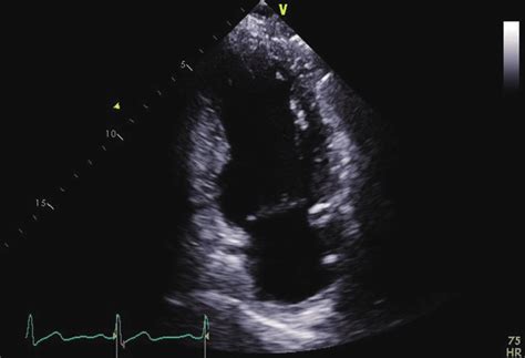 Interestingly, only the transplanted sa nodal activity is able to conduct to the ventricles since the surgical anastomotic site creates an electrical block not. Apical two chamber view echocardiogram. Apical 2 chamber ...