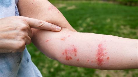 What Causes Poison Ivy Rash To Spread