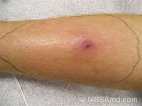49 Best Staph Infection Images On Pinterest