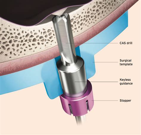 Onecas Kit Guided Sinus Lifting Implantology Osstem Uk