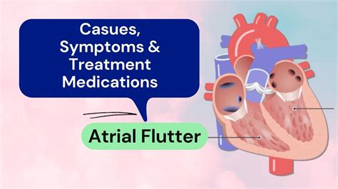 Atrial Flutter Causes Symptoms Treatment Atrial Flutter Images