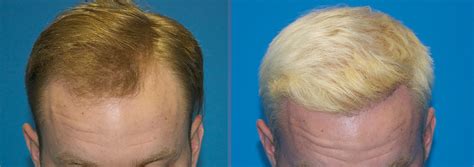 Frontal Forelock 2000 Graft FUE Hair Transplant Case Study Carolina