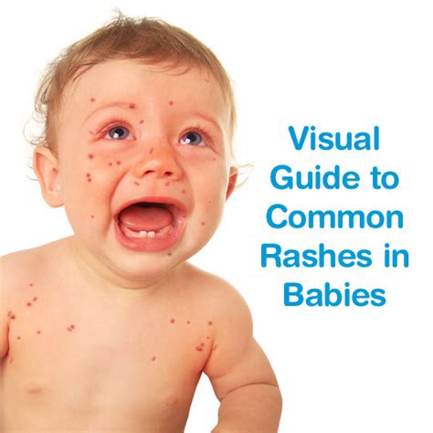 Viral Rashes On Babies