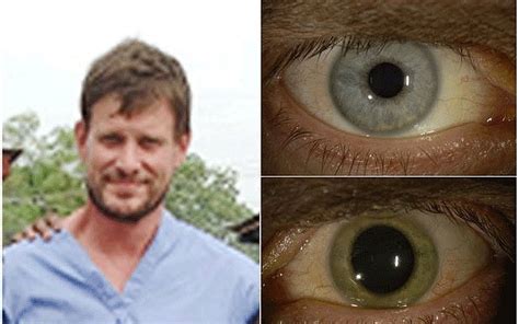 ヤバい エボラから回復した男性の 目 にウイルスが生き残ってて青い瞳が緑に変色 うしみつ 5chまとめ