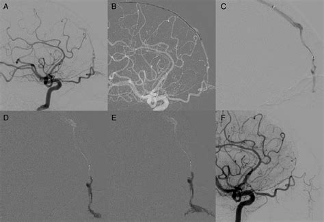 Endovascular Treatment Of Cribriform Plate Dural Arteriovenous Fistulas