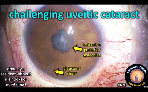 Review Uveitis Glaucoma Cataract Cataract Coach