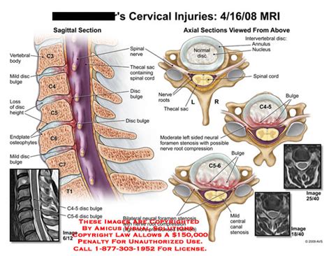 Amicus Illustration Of Amicus Injury Cervical Mri Neural Foramen My