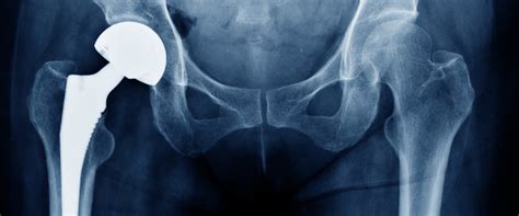 5 Signs You Need A Hip Replacement Orthopedic Associates Of Hartford