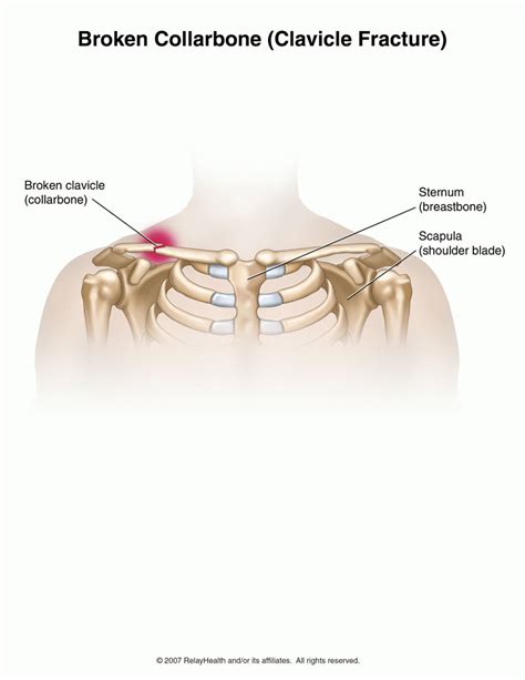 Hard Lump On Collarbone Near Sternum Clavicle Fracture Broken
