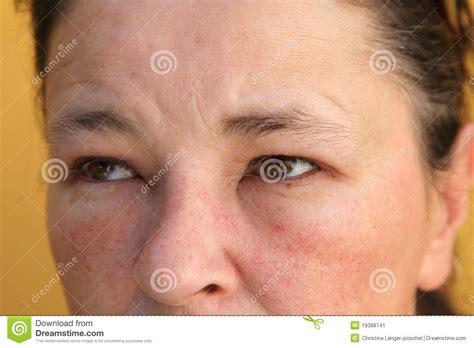 Allergies Swollen Eyes And Face Stock Image Image Of Common Health