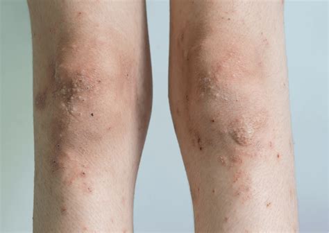 Kaj povzroča dermatitis in kako ublažiti simptome Gaia Naturelle
