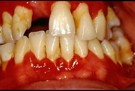 Gingivitis Mouth And Dental Disorders Merck Manuals Consumer Version