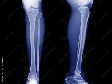 X Ray Image Of Leg Front View And Side View Xray Of Normal Leg Bone